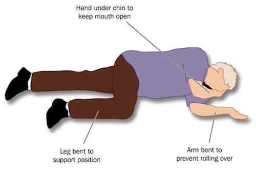 32082906 - patient placed in the recovery position to ensure a clear airway for adequate breathing and to prevent inhalation of vomit.